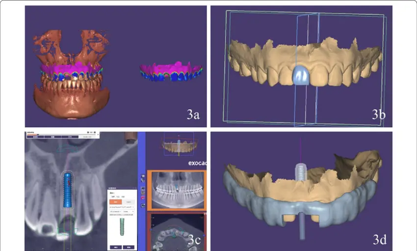 Digital surgical guide design a Intraoral scan and CBCT scan superimposed using AI