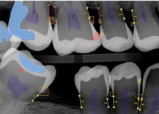 Dental x ray with AI